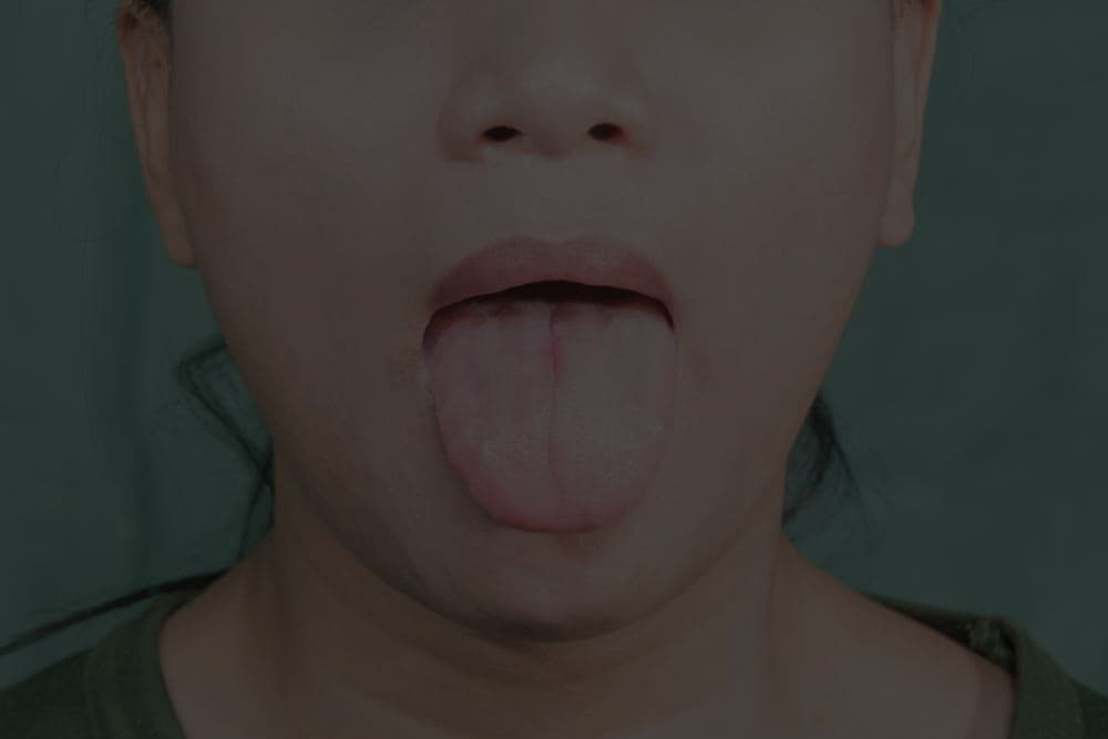 What Is The Geographic Tongue Causes And Treatment Smile Care